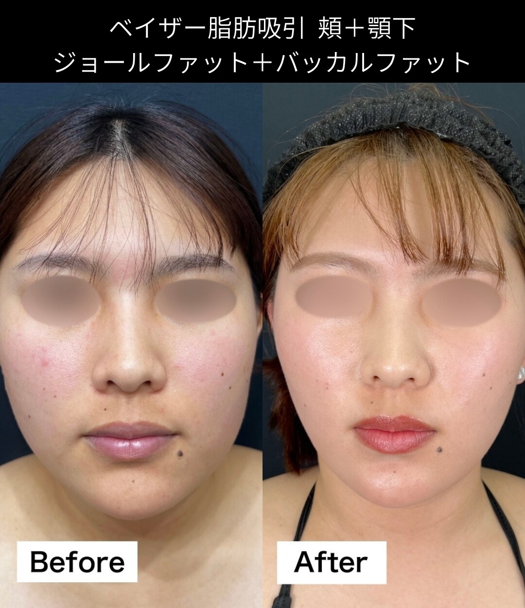 脂肪吸引の症例写真