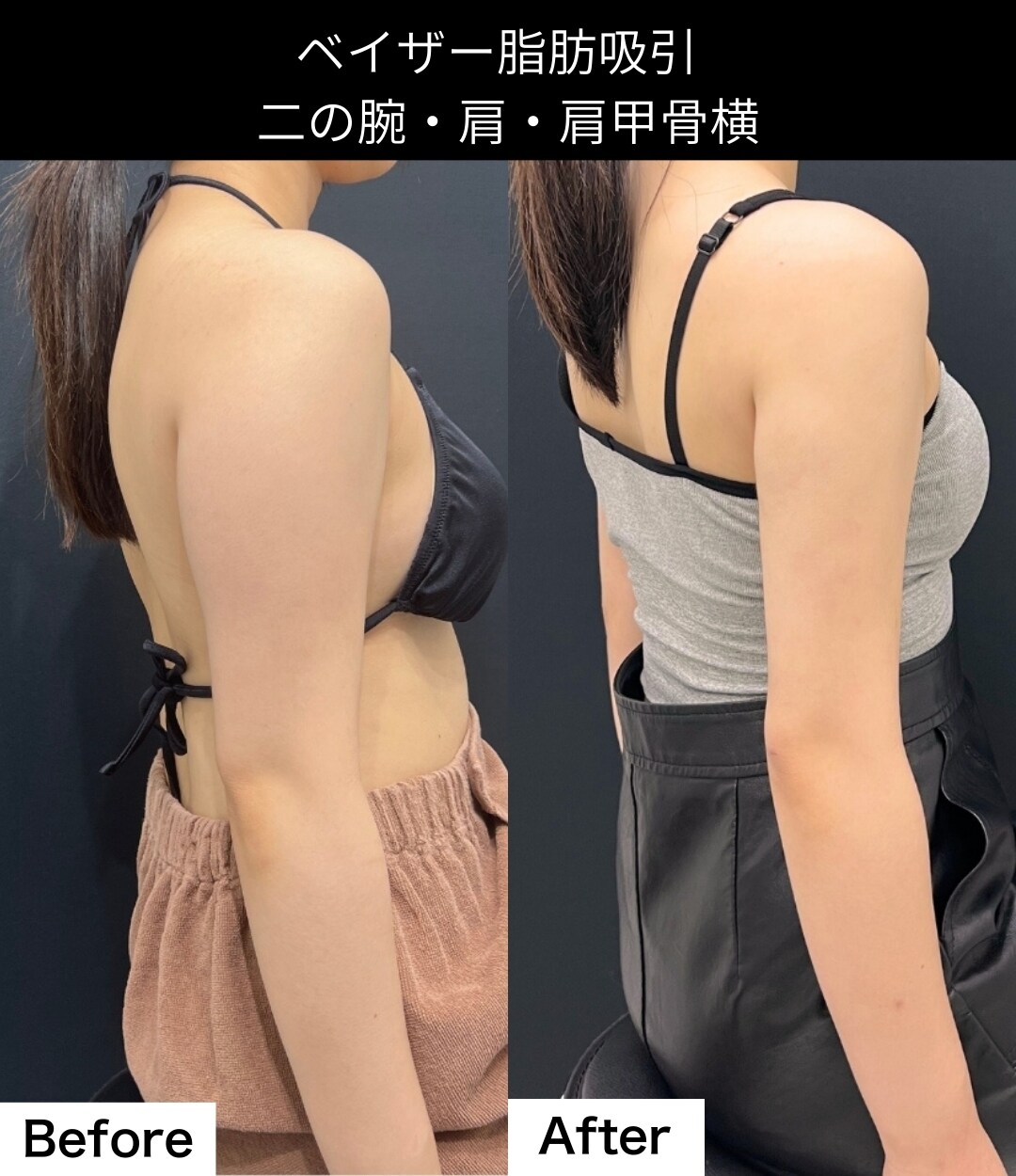 脂肪吸引の症例写真