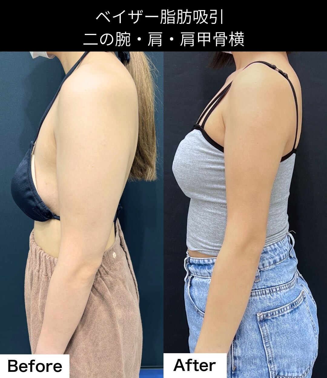 脂肪吸引の症例写真