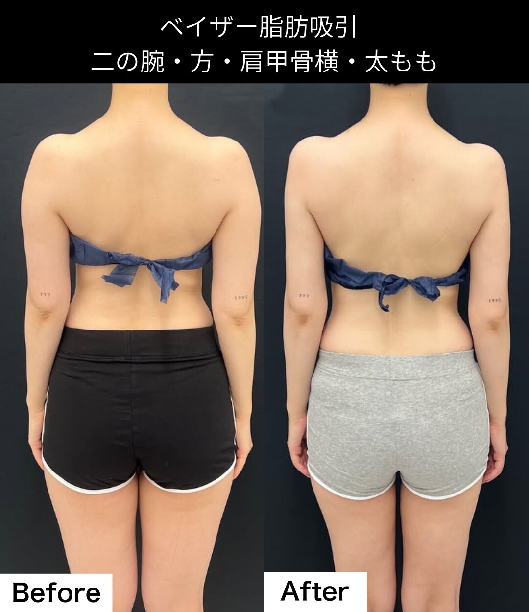 脂肪吸引の症例写真