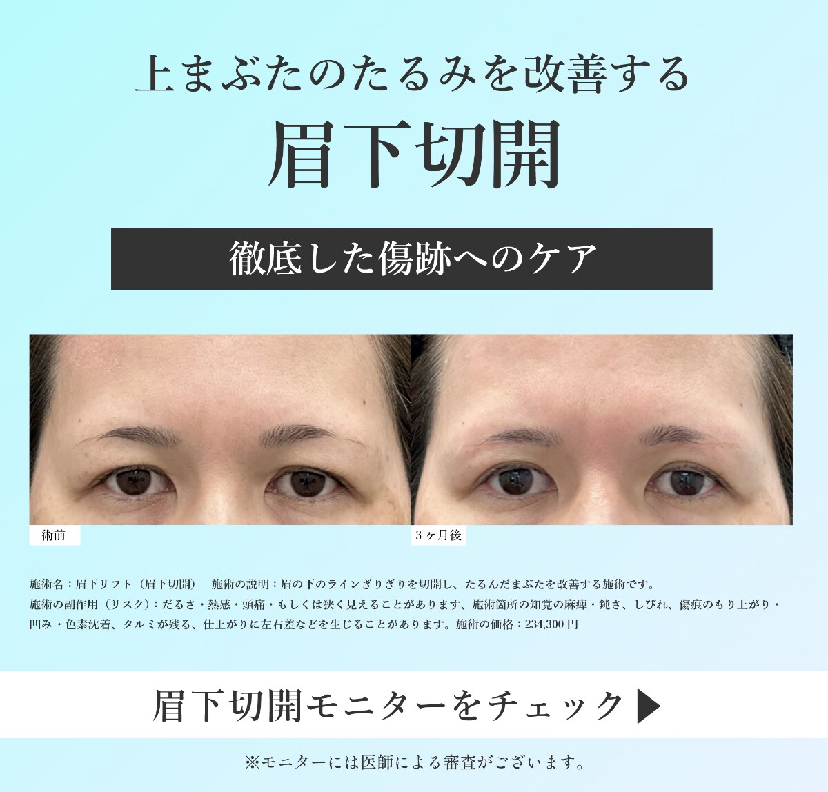 眉下切開