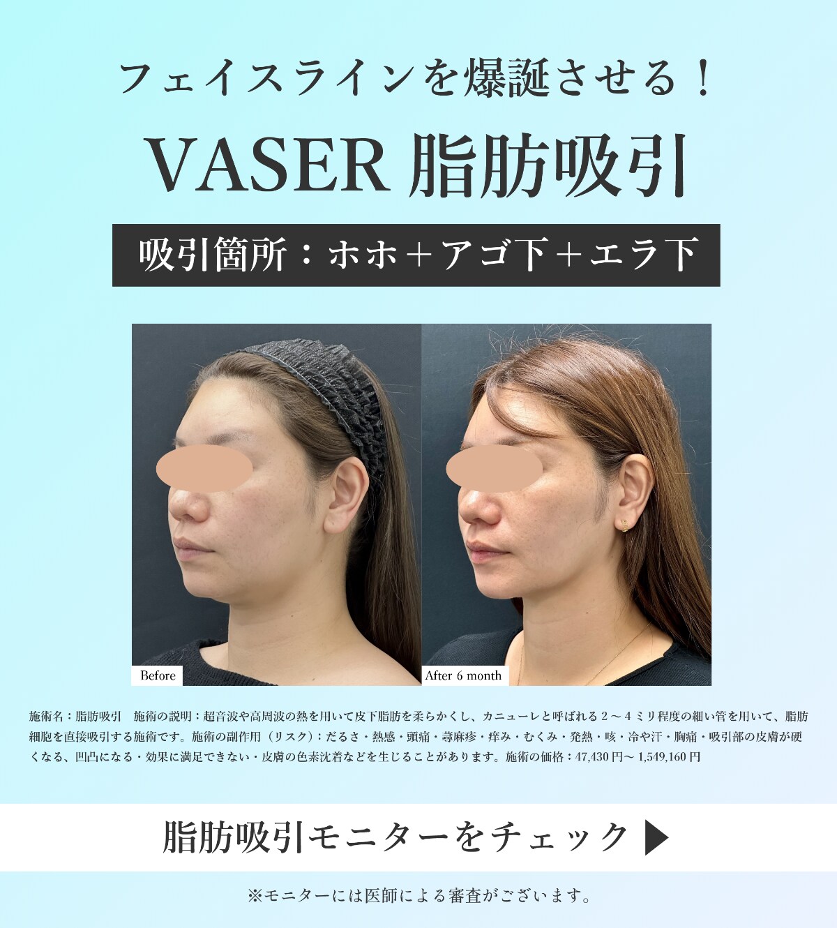 脂肪吸引