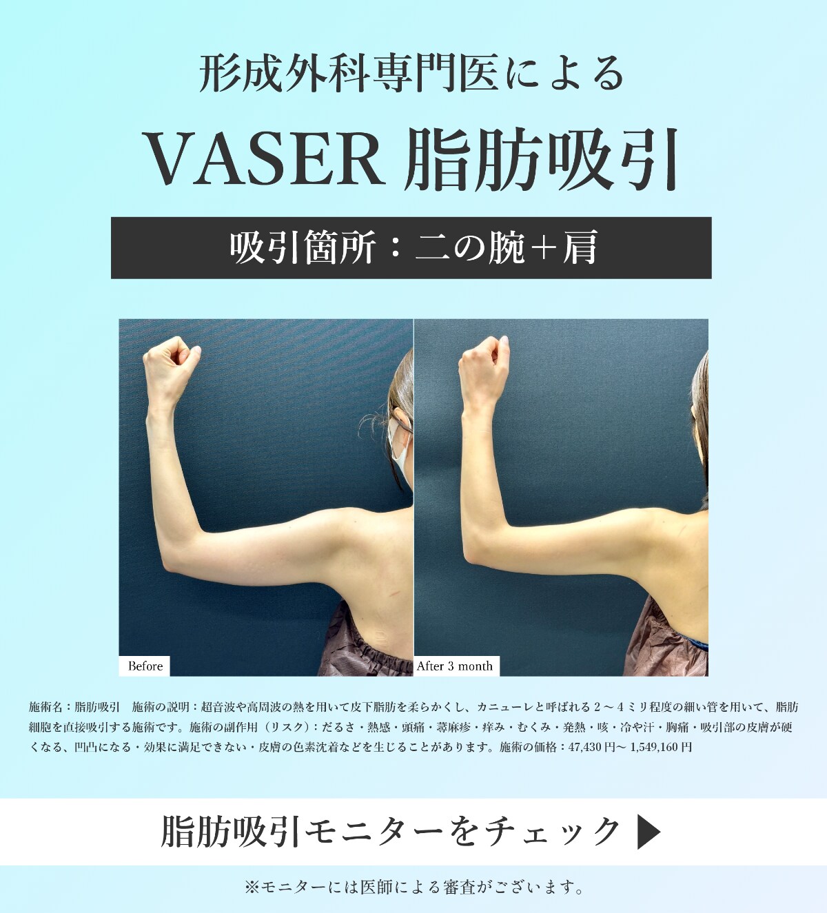 脂肪吸引