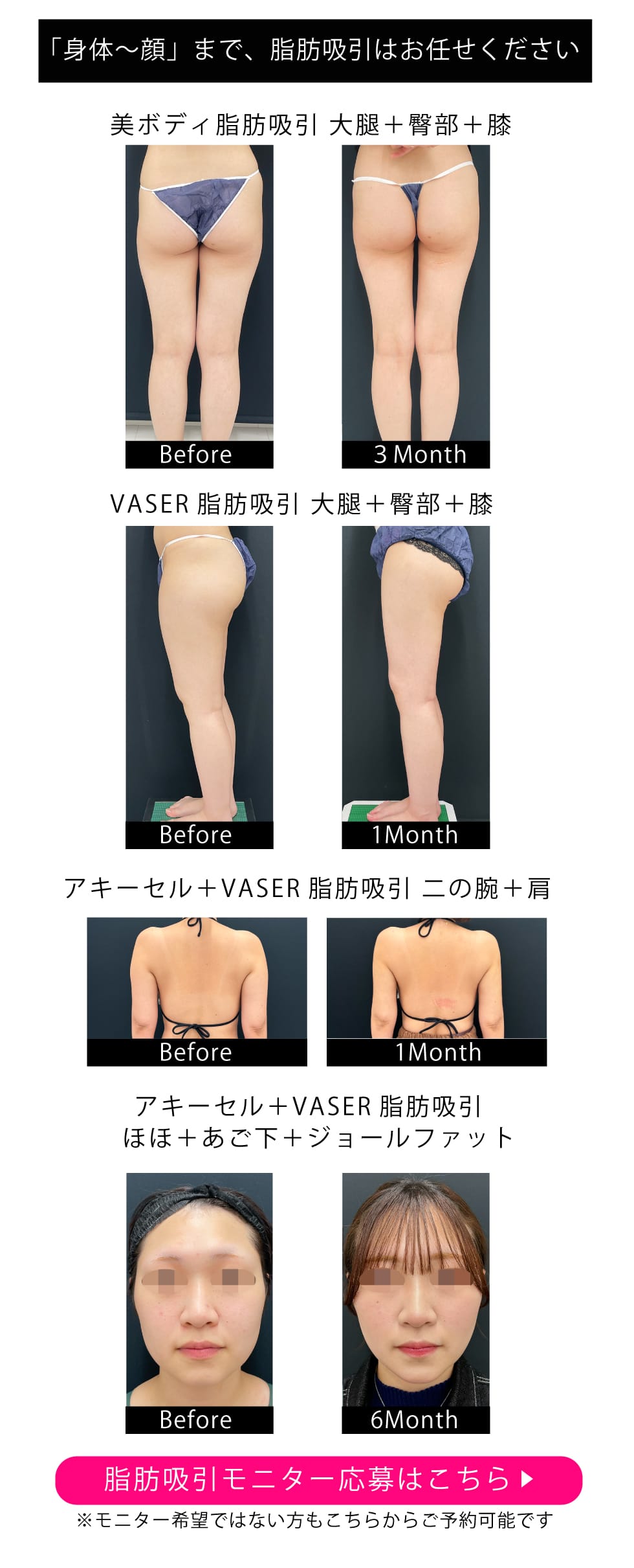 脂肪吸引モニター