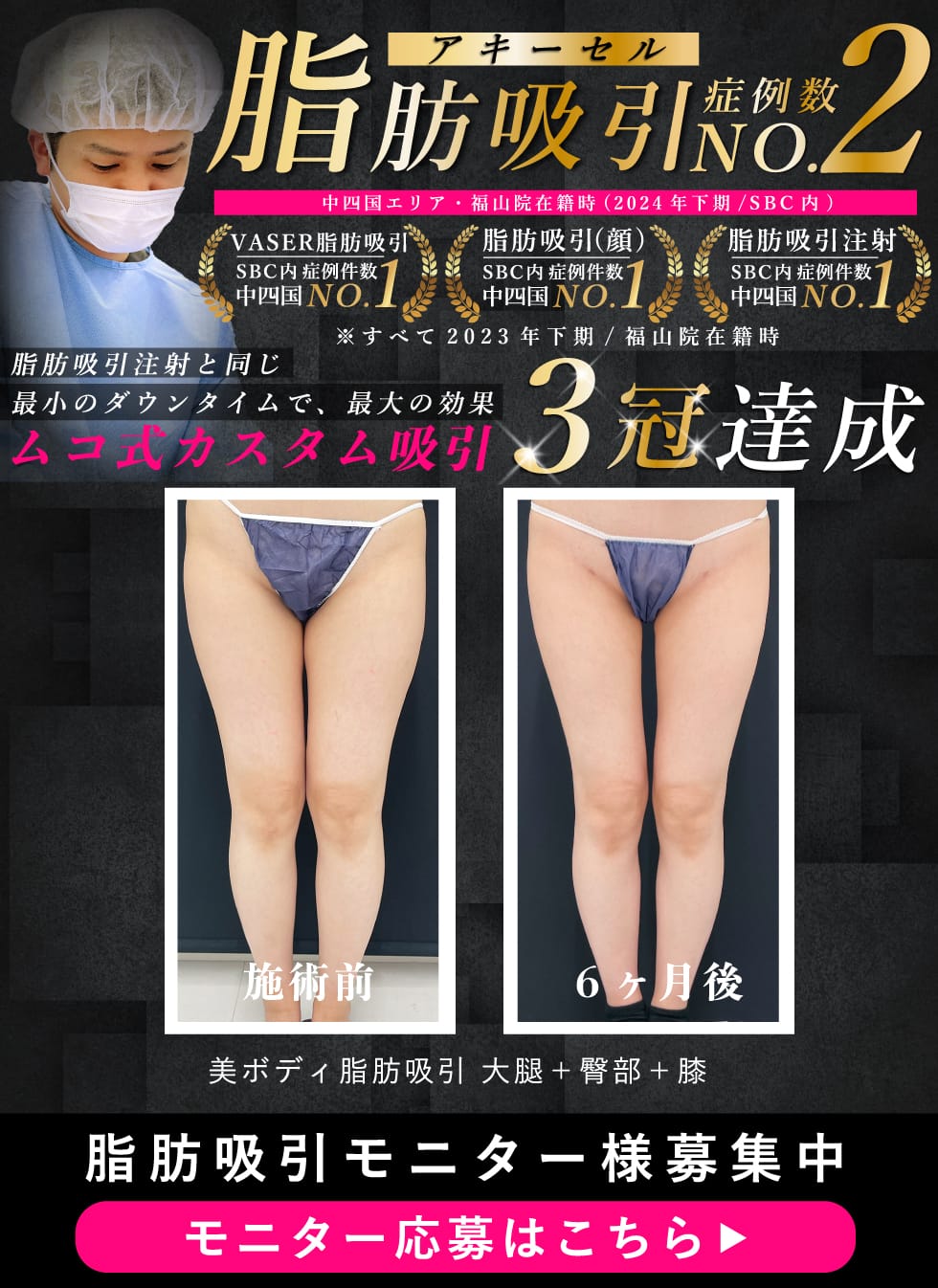 脂肪吸引No.2