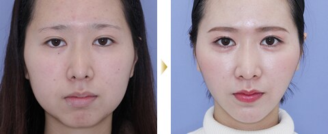 美容外科専門医が叶える小顔術 美容整形 美容外科 美容皮膚科なら湘南美容クリニック 公式