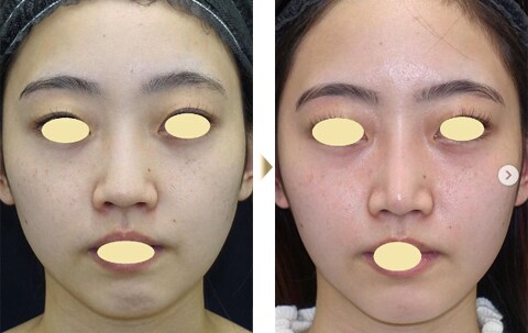 ナチュラル美鼻特集 美容整形 美容外科 美容皮膚科なら湘南美容クリニック 公式