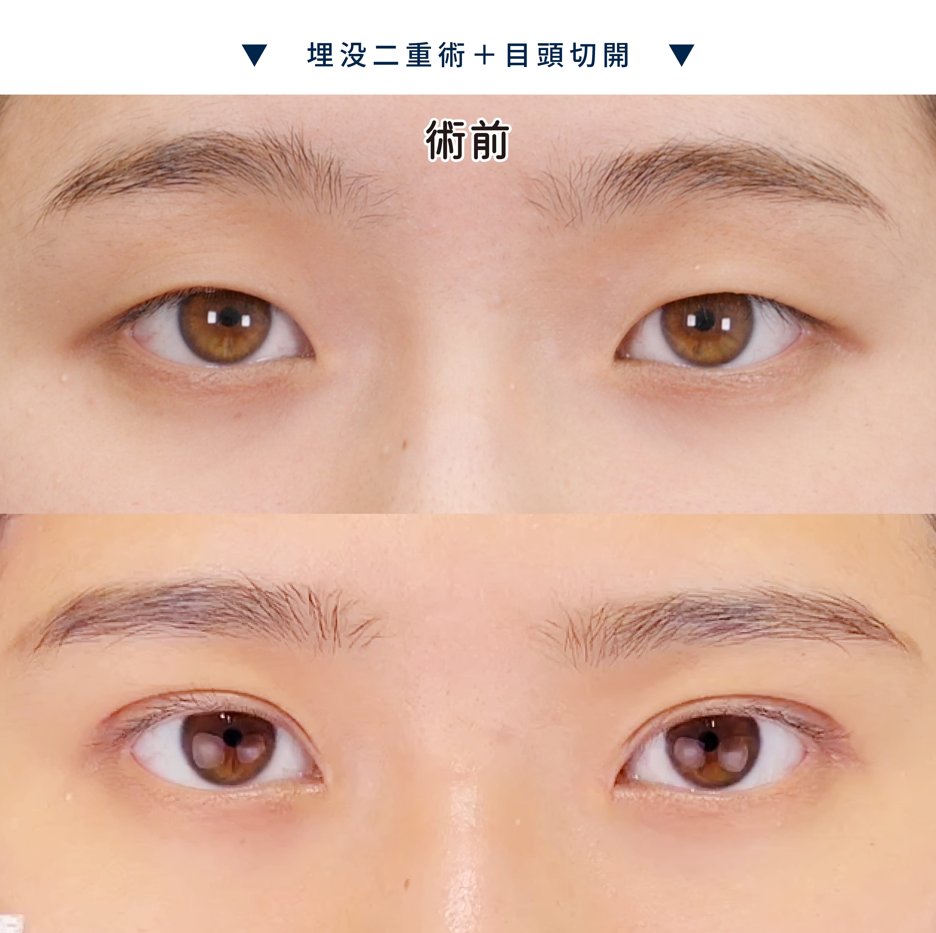 目元整形症例