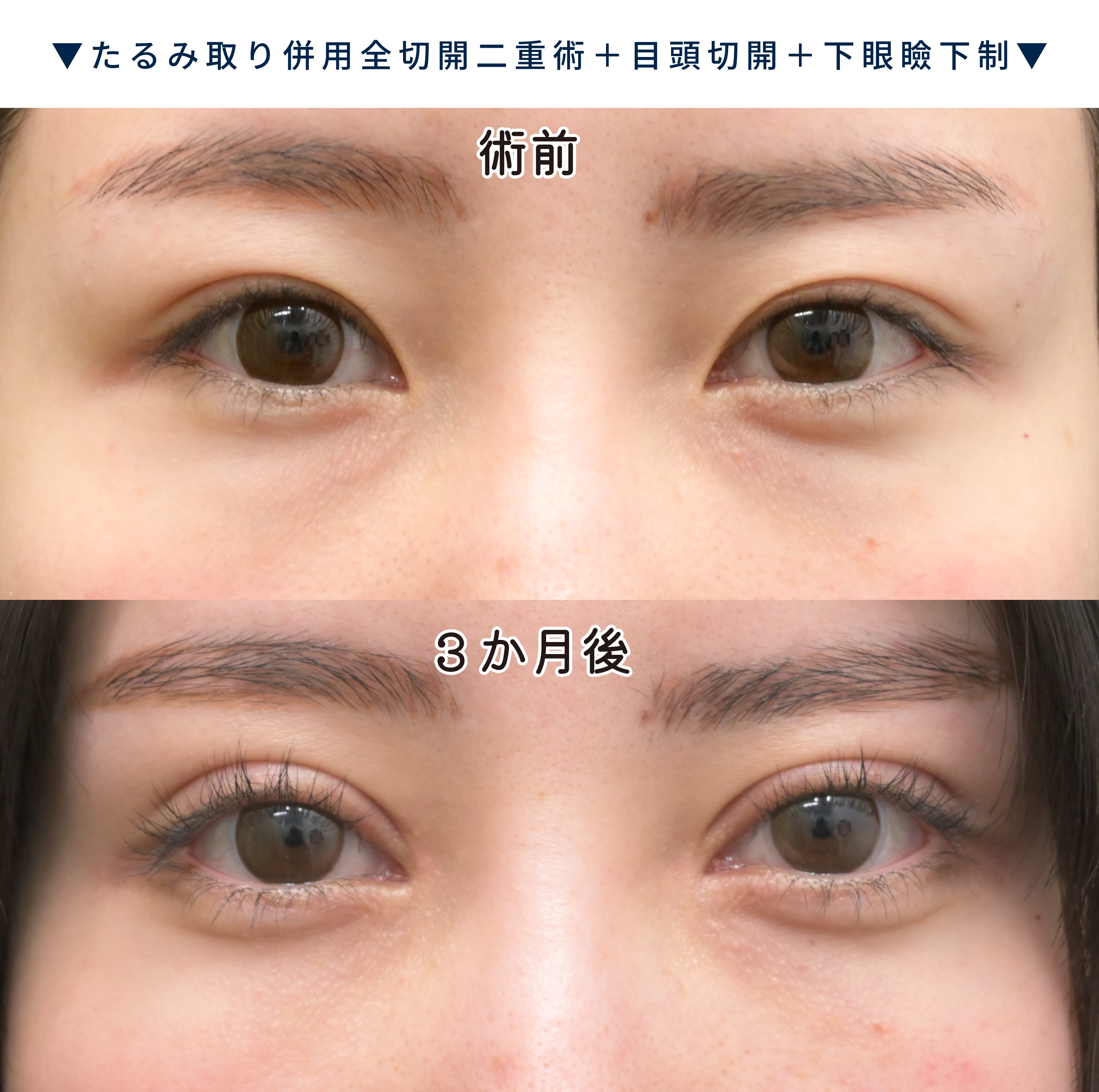 目元整形症例