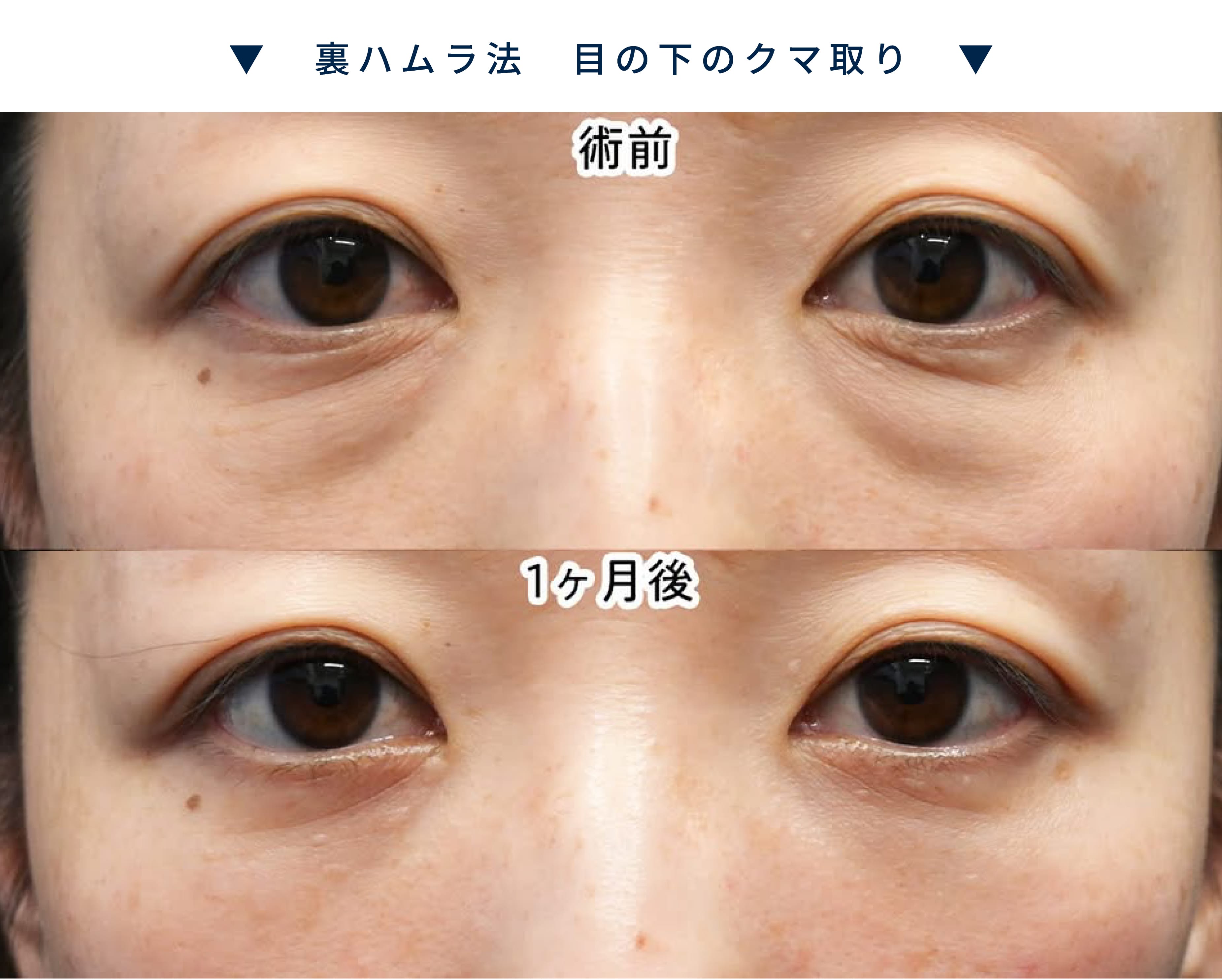目元整形症例