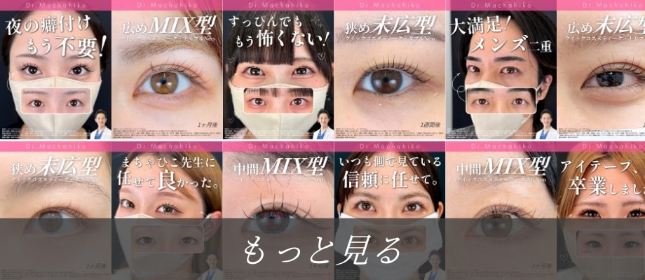 二重整形症例インスタグラム