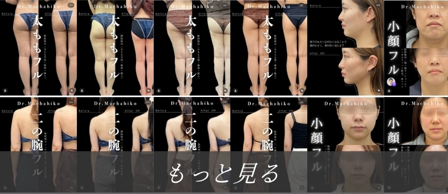 脂肪吸引症例インスタグラム
