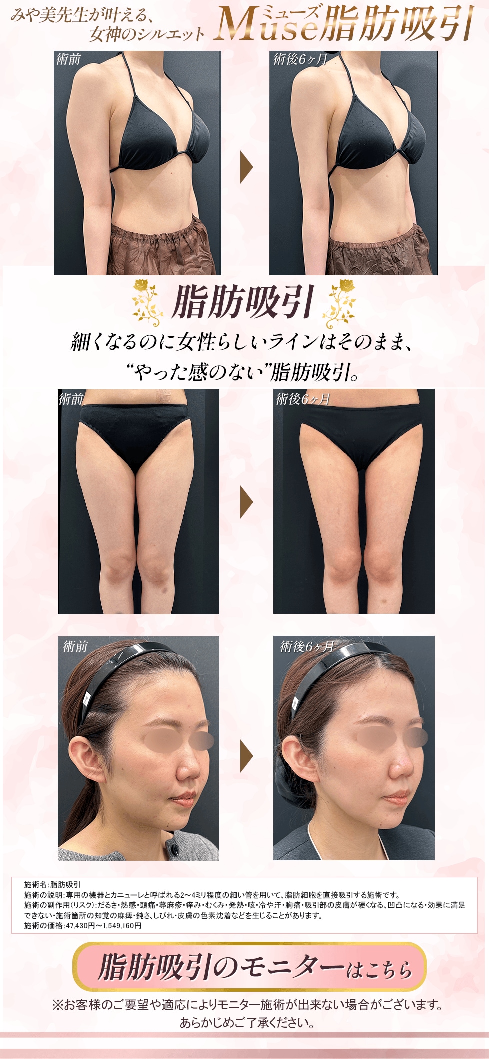 脂肪吸引