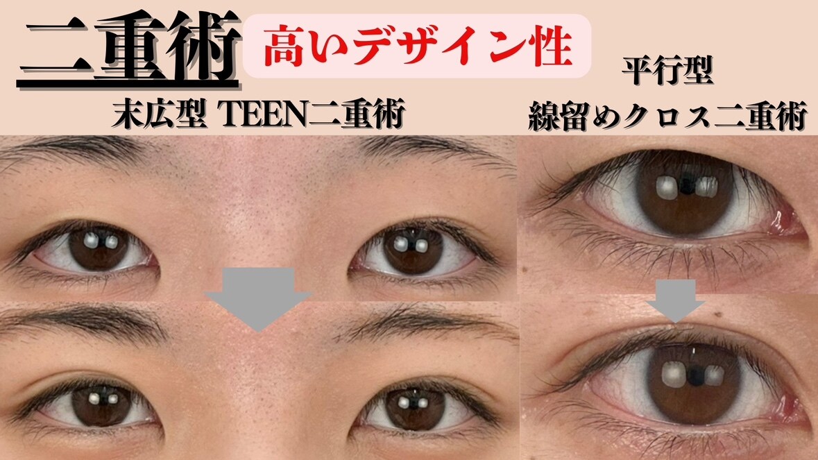 二重術
