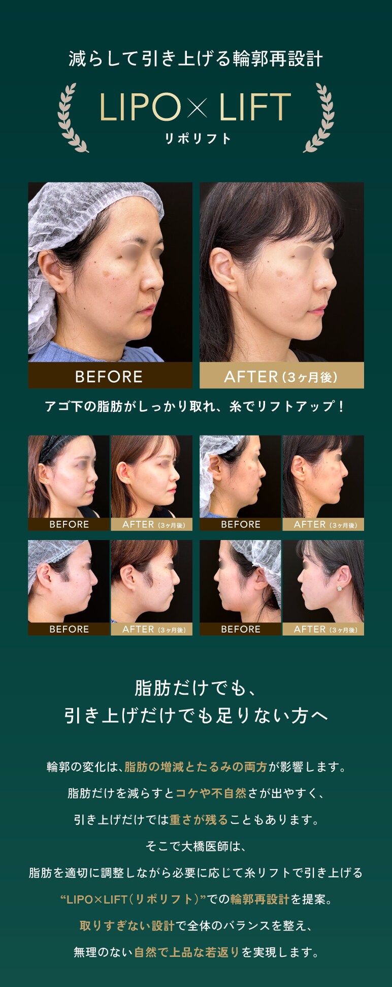 リポリフト