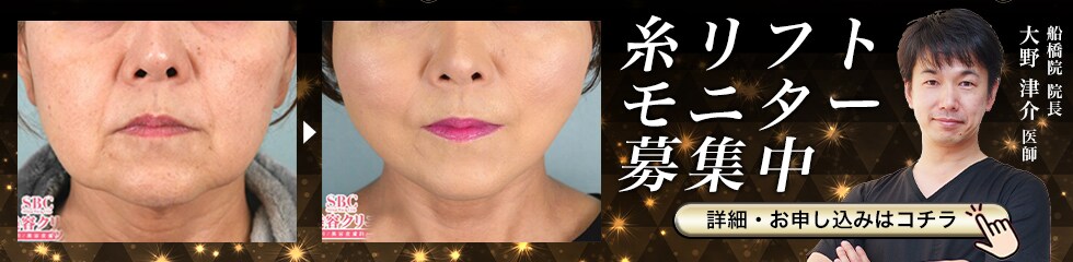 糸リフトモニター募集中