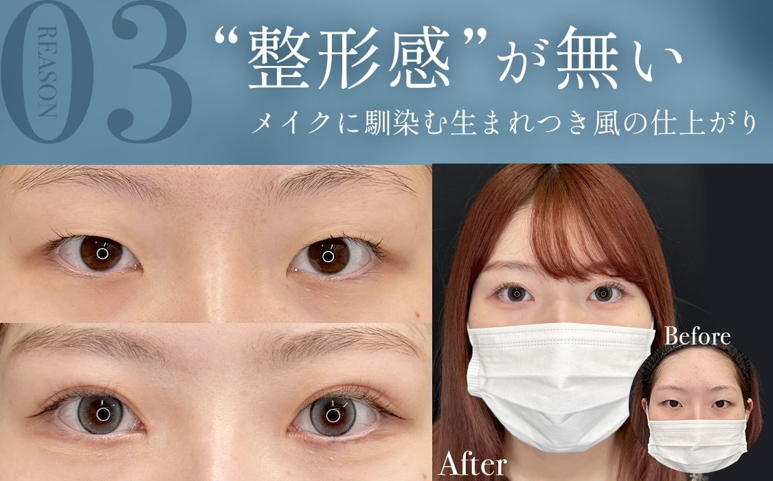 選ばれる理由3:“整形感”が無い、メイクに馴染む生まれつき風の仕上がり