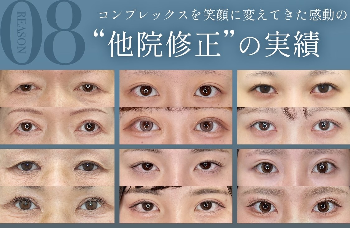 選ばれる理由8:コンプレックスを笑顔に変えてきた感動の“他院修正”の実績