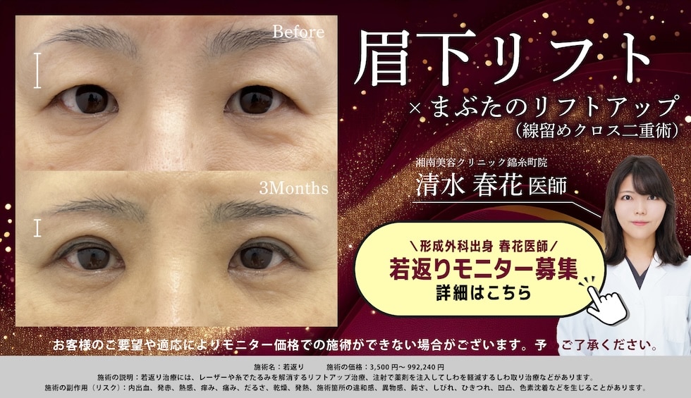 眉下リフト まぶたのリフトアップ