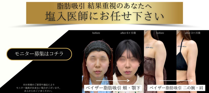 脂肪吸引モニター募集