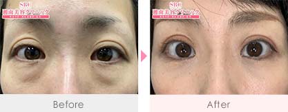 目の下の切らないクマ・たるみ（ふくらみ）取り＋脂肪注入