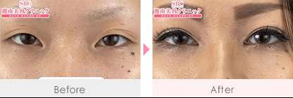 目頭切開プレミアム