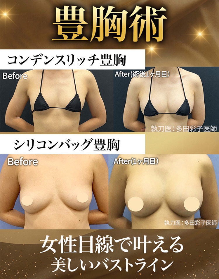 豊胸症例