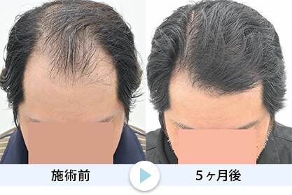 毛根再生1