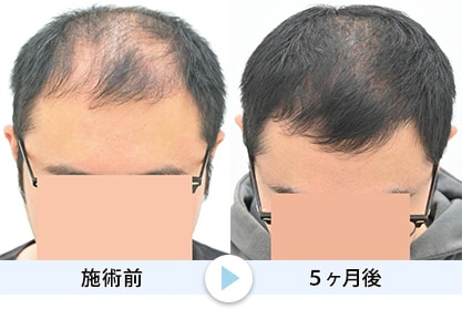 毛根再生2