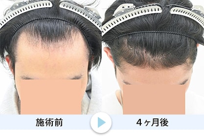 毛根再生3