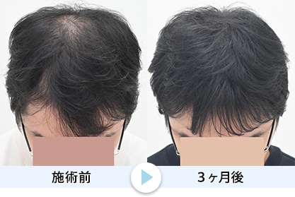 毛根再生4