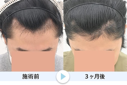 毛根再生5