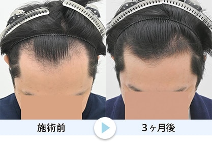 毛根再生6