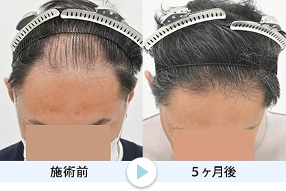 毛根再生7