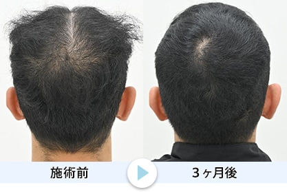 毛根再生8