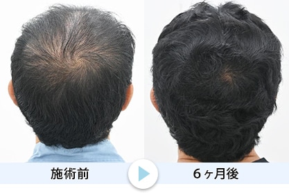 毛根再生9