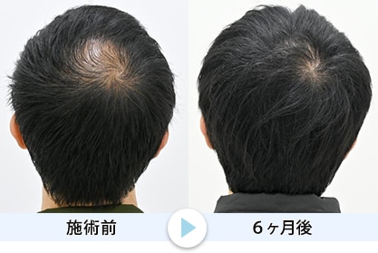 毛根再生10