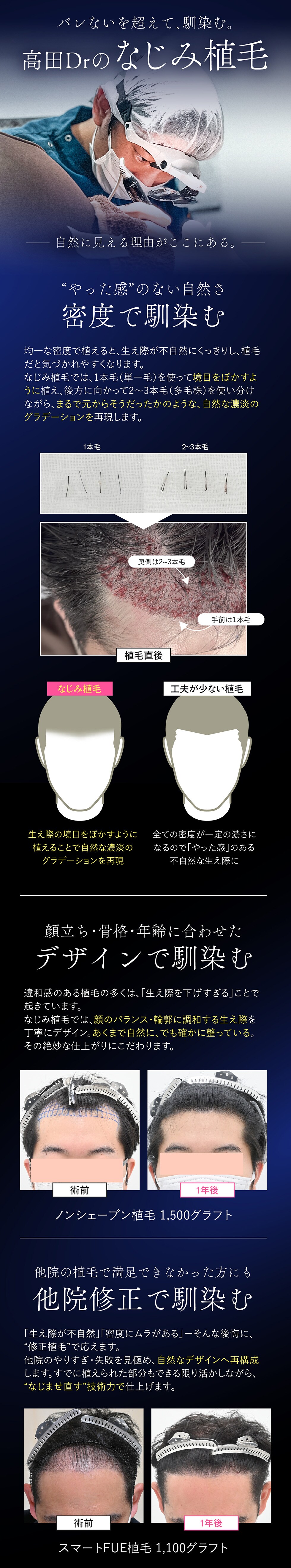 なじみ植毛