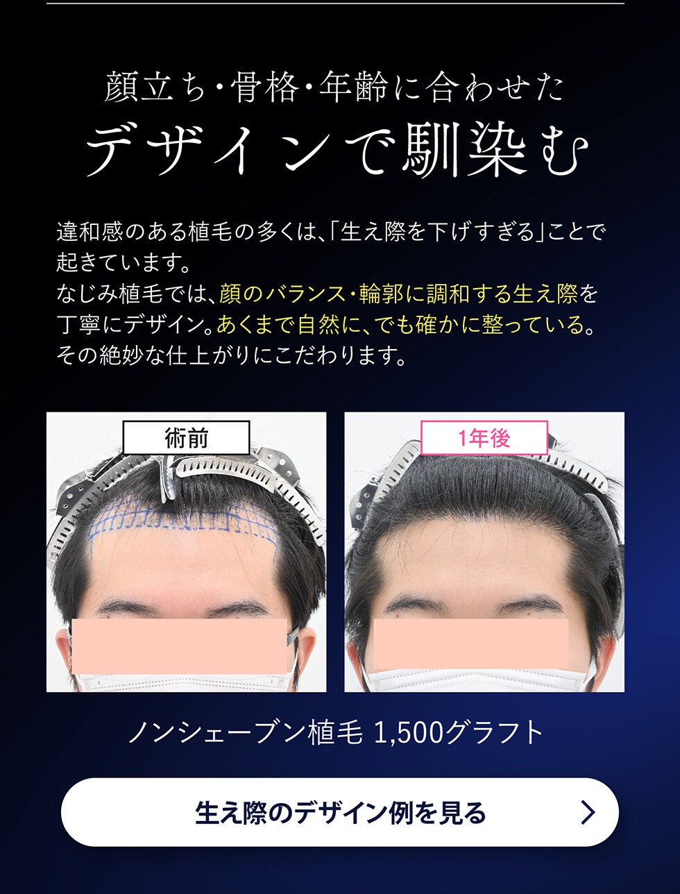 なじみ植毛