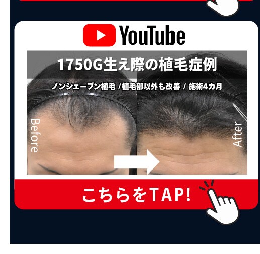 Instagram 目の下のクマ治療