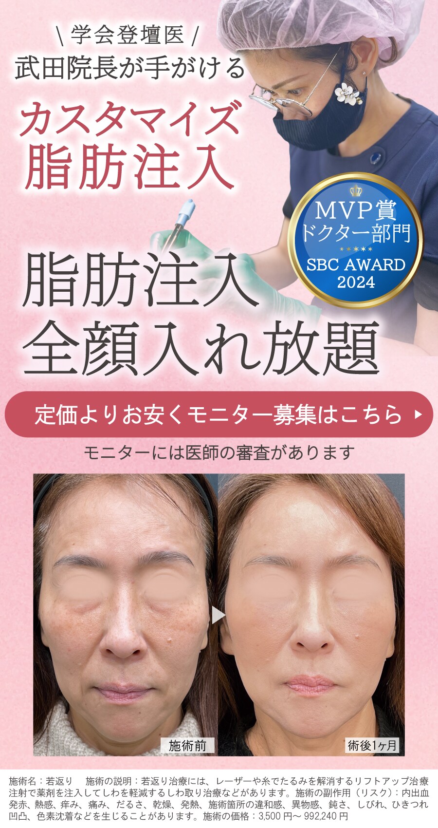 脂肪注入全顔入れ放題