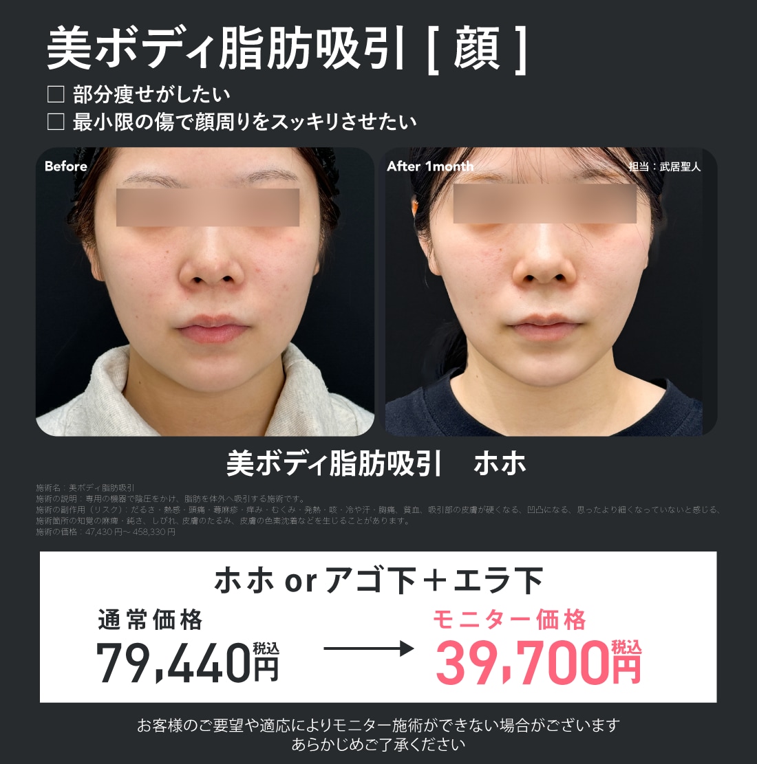 美ボディ脂肪吸引 顔