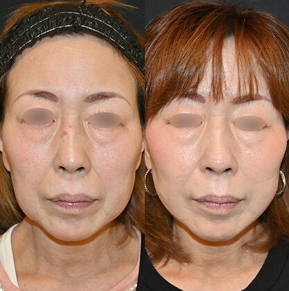 糸リフトの症例写真