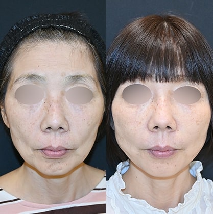 糸リフトの症例写真