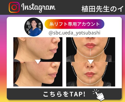 糸リフト Instagram