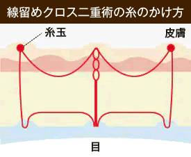 フォーエバー二重の糸のかけ方