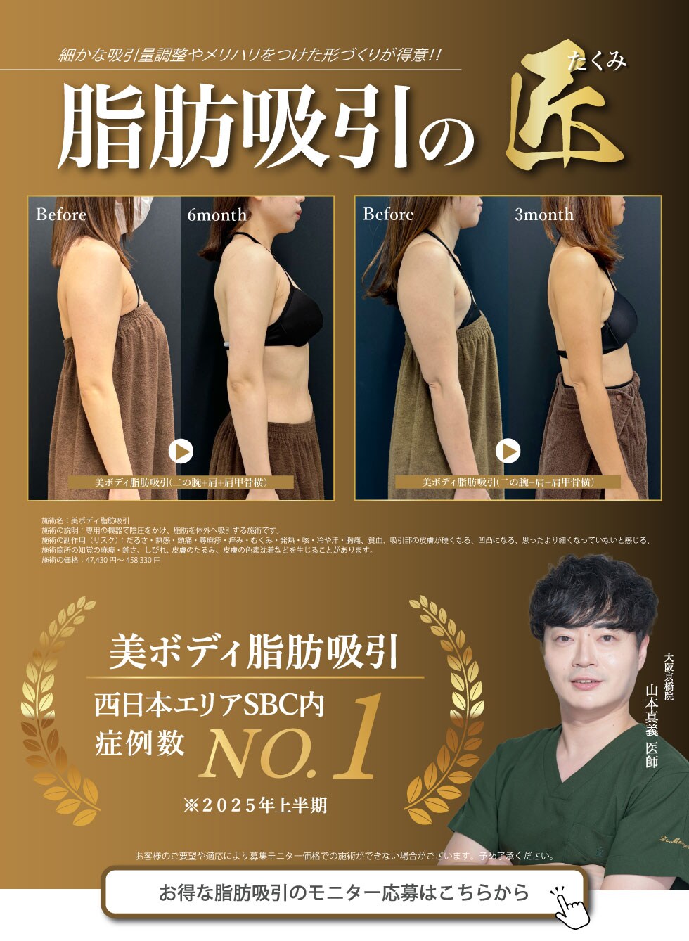 脂肪吸引の匠