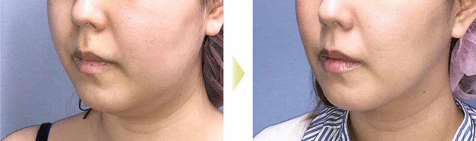 術後3ヶ月 症例写真