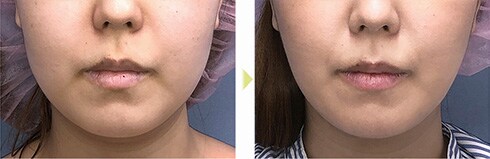 術後3ヶ月 症例写真2