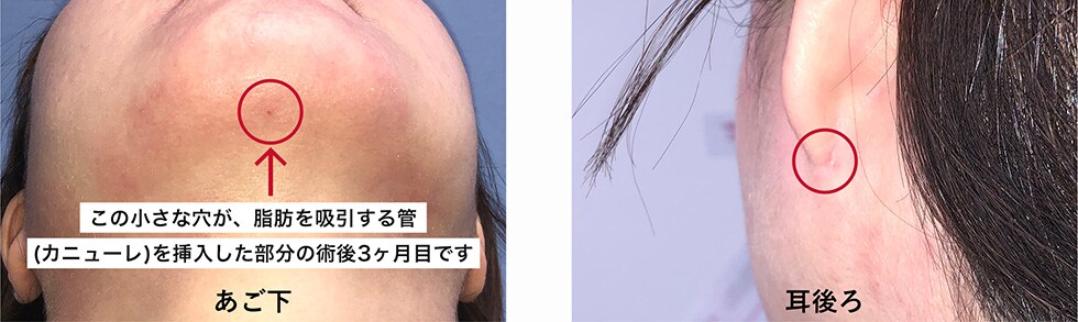 術後１ヶ月 症例写真